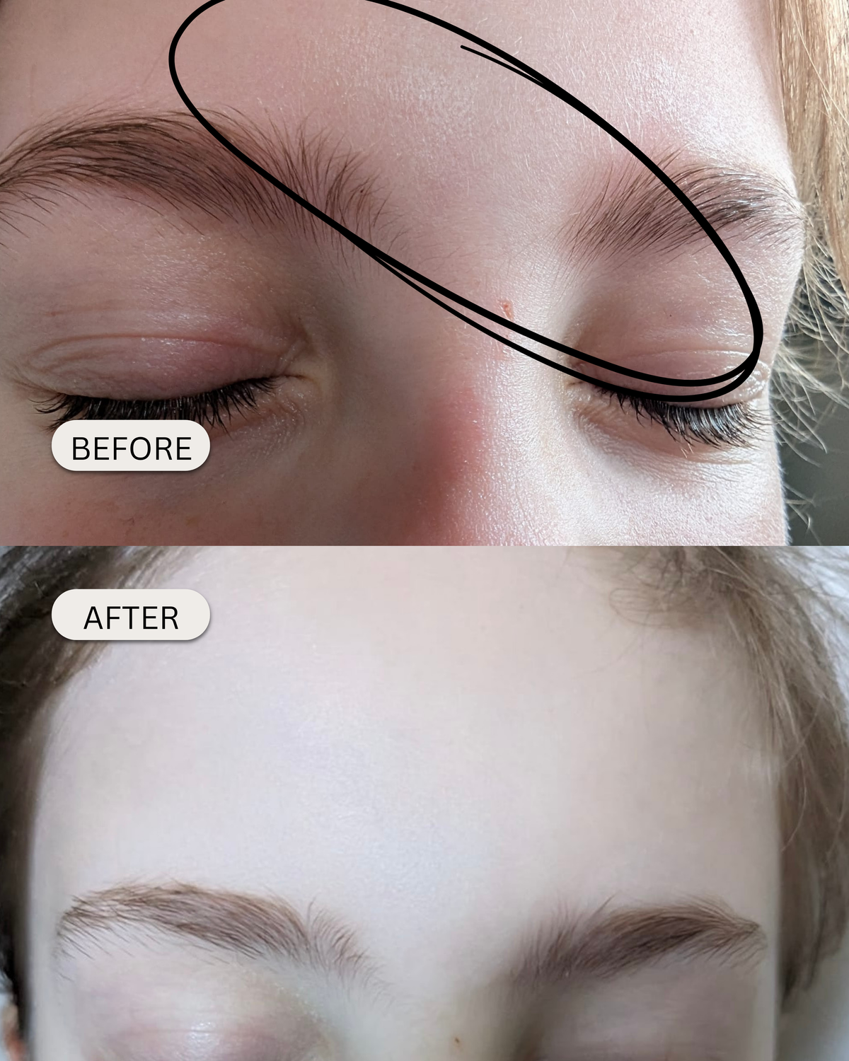 young girls dry skin improved with Little Bay Skin Restoring butter powered with hemp and milk thistle.
